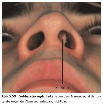 Septumdeviation (Verkrümmung der Nasenscheidewand) › Praxis für HNO